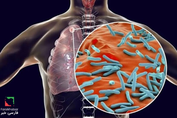 بیماری سل در ایران: آمارهای هولناک از ابتلای 6500 نفر در یک سال!