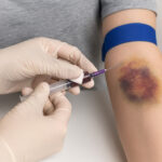 بیماری هموفیلی؛ چرا بیماران هنوز قربانی کمبود دارو هستند؟