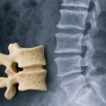 پوکی استخوان: علائم اولیه و روش‌های تشخیص زودهنگام