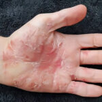 بیماری پسوریازیس.. وقتی پوست به خودش حمله می‌کند!بیماری پسوریازیس.. وقتی پوست به خودش حمله می‌کند!