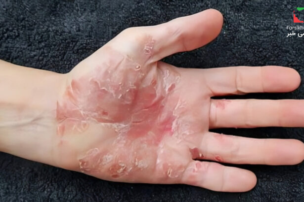 بیماری پسوریازیس.. وقتی پوست به خودش حمله می‌کند!بیماری پسوریازیس.. وقتی پوست به خودش حمله می‌کند!