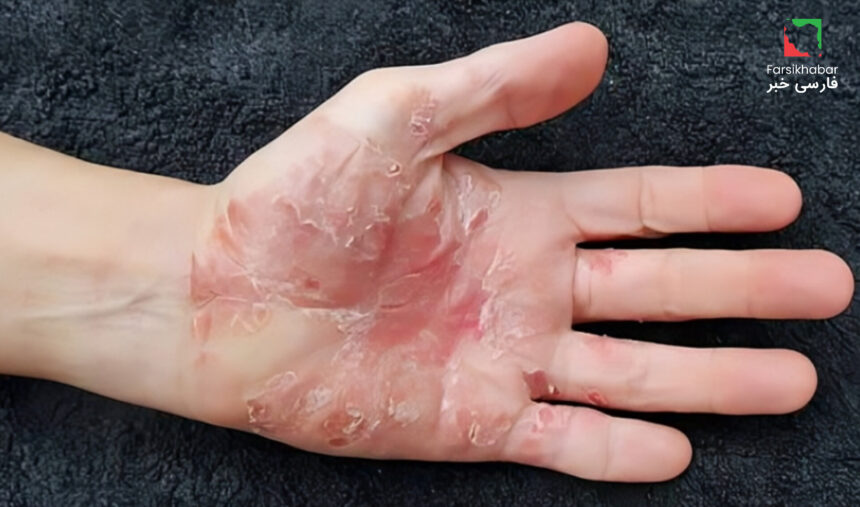 بیماری پسوریازیس.. وقتی پوست به خودش حمله می‌کند!بیماری پسوریازیس.. وقتی پوست به خودش حمله می‌کند!