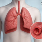 بیماری مزمن انسداد ریه: روش‌های پیشگیری و تغییر سبک زندگی
