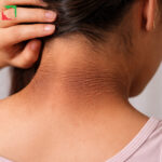 سندروم پوست مخملی؛ نشانه‌ای پنهان از اختلالات درونی بدن