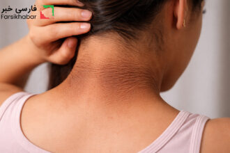 سندروم پوست مخملی؛ نشانه‌ای پنهان از اختلالات درونی بدن