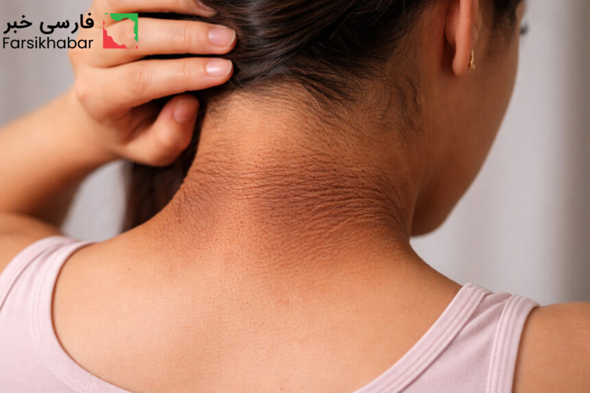 سندروم پوست مخملی؛ نشانه‌ای پنهان از اختلالات درونی بدن