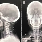 سرکوب خونین معترضان ایران؛ بررسی گسترده جراحات و پیامدها